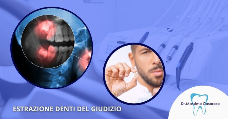 Estrazione denti del giudizio Forte dei Marmi Studio Dentistico Massimo Casarosa